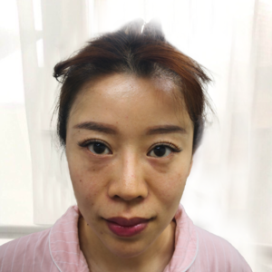 脂肪填充+内路眼袋精品日记