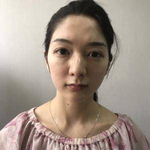 自体脂肪面部填充精品日记