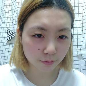 万家燕医院面部吸脂瘦脸