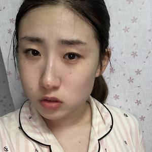 万家燕面部吸脂