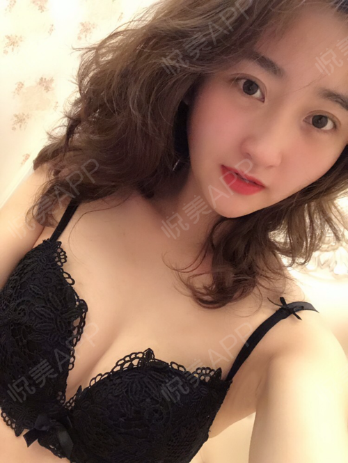 那天曹阳丽格的小姐姐跟我联系，我才反应过来我做自体脂肪丰胸的手术居然都一年了也，突然觉得好感慨~~之前我是属于生完宝宝后...