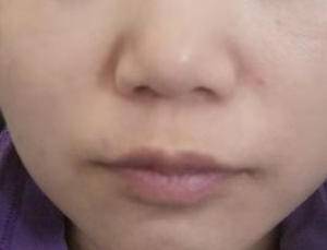 现在快掉完痂了，也不肿了