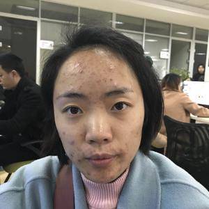 我的祛痘日记