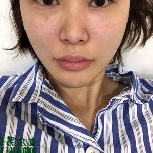 张琦琦隆鼻日记