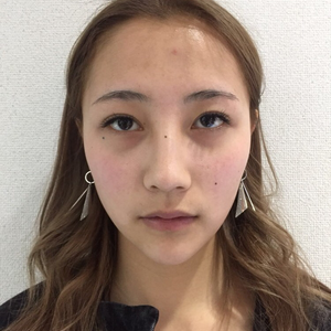 全面部填充
