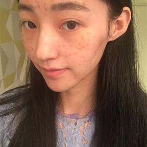 我的去痘印日记