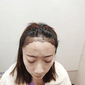 元气少女，分享植发经验