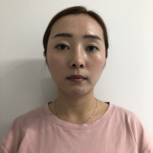 埋线提升的