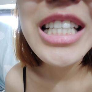 时代天使矫正牙齿