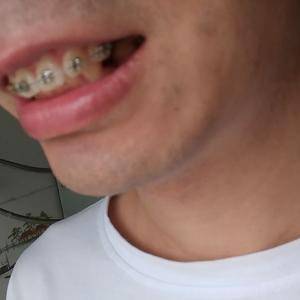 矫正牙齿叶