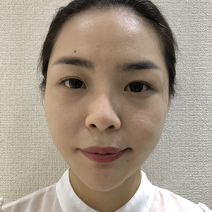 自体脂肪面部填充