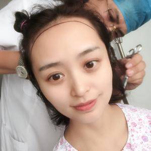 种植发际线后，可以快乐的扎丸子头啦