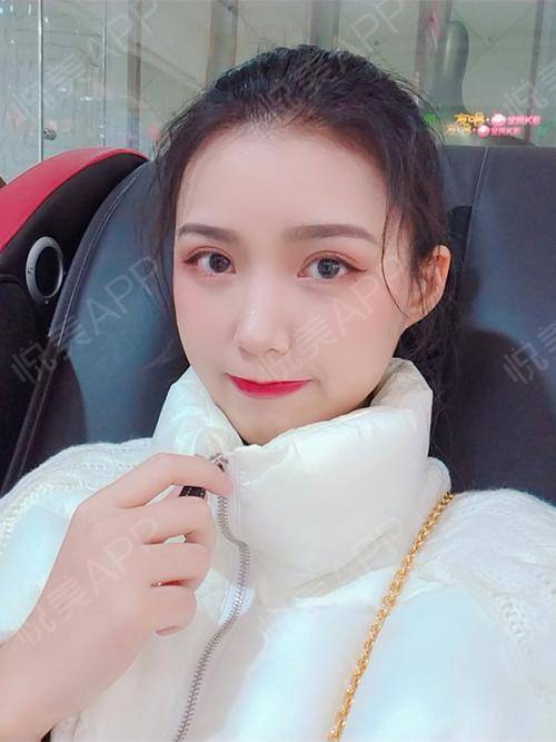 现在无论是双眼皮还是内眼角都恢复得很好了，宽度是我喜欢的样子，眼睛特别有神，画一点眼影就超好看的女孩子还是要有一对双眼皮...